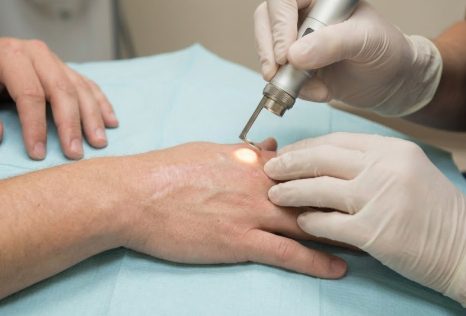 화상 흉터 레이저 비용 얼마부터 시작할까? 시술 종류별 실제 가격 정리